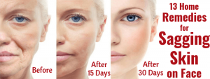 Remedies for Sagging Skin on Face