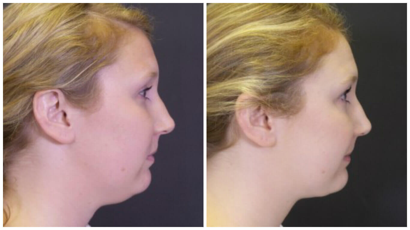 Liposuction Before and After