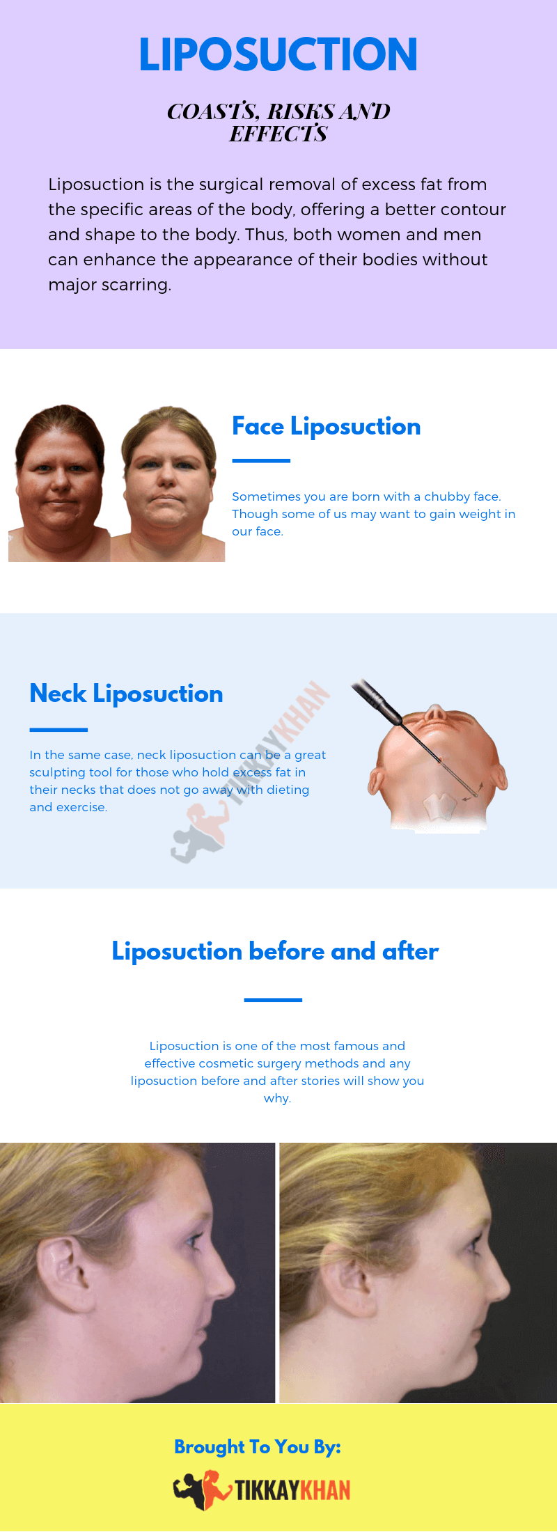 Liposuction Infographic by TikkayKhan